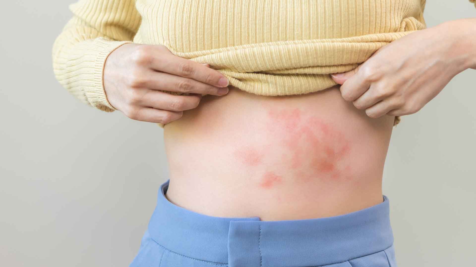 These signs can indicate shingles!