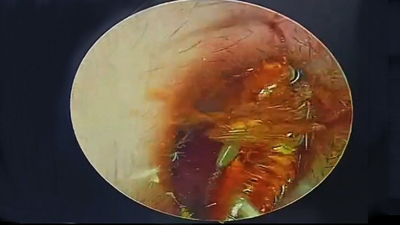 Kribbeln im Ohr: Arzt zieht Küchenschabe aus Gehörgang