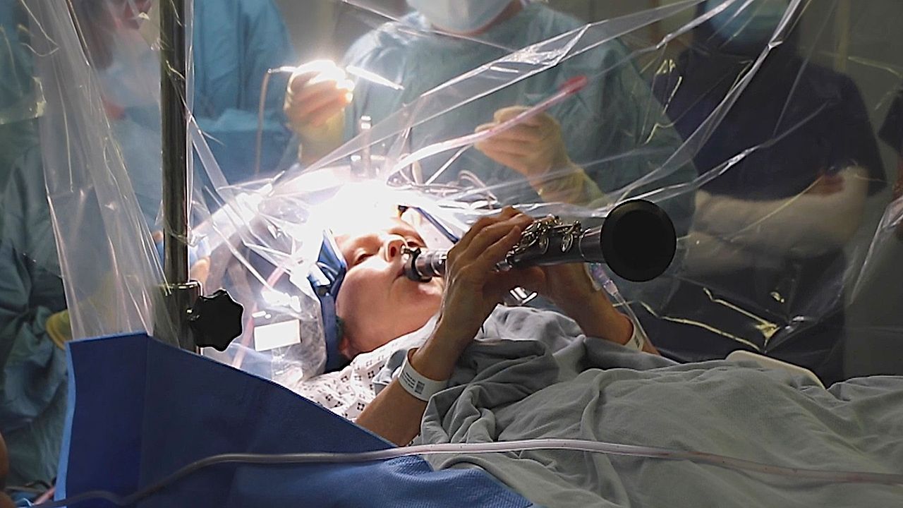 Parkinson's patient plays clarinet during brain surgery with instant improvement
