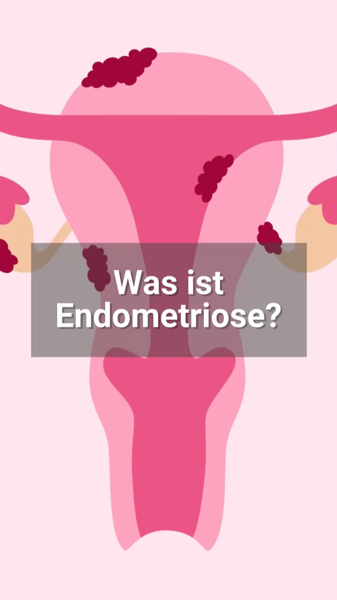 Simply Explained: Endometriosis