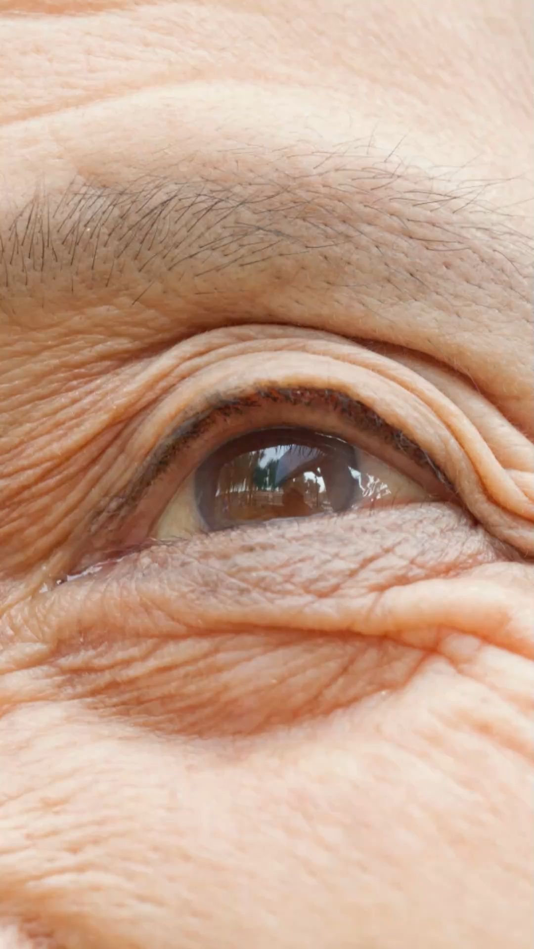 Bags under the Eyes: Tips and Home Remedies for Swelling Under the Eye