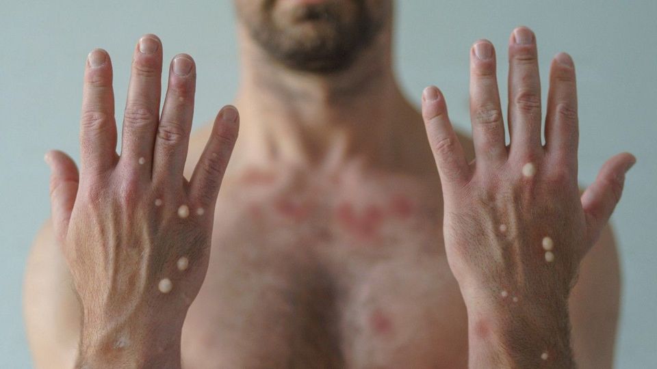 Weltweite Notlage wegen Mpox – nicht genügend Impfstoff
